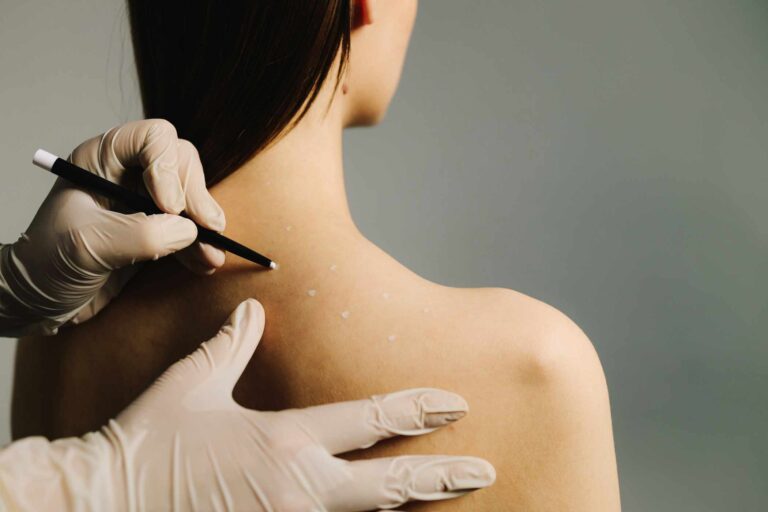Treatment mapping points marked on skin for a non-invasive sculpting session